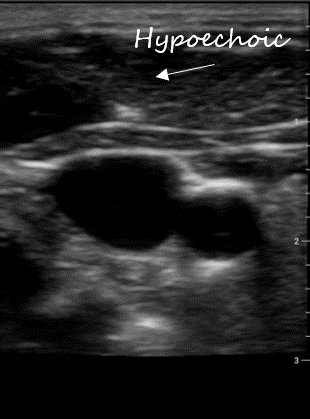 The Basics – Toronto Internal Medicine POCUS