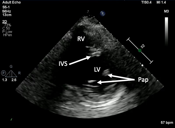 Cardiac Views – Toronto Internal Medicine POCUS