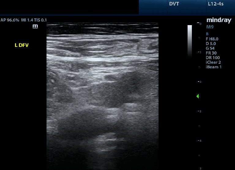Lower Extremity DVT – Toronto Internal Medicine POCUS
