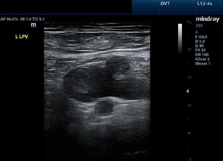 Lower Extremity DVT – Toronto Internal Medicine POCUS